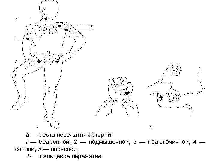 Как производится пальцевое прижатие подключичной артерии