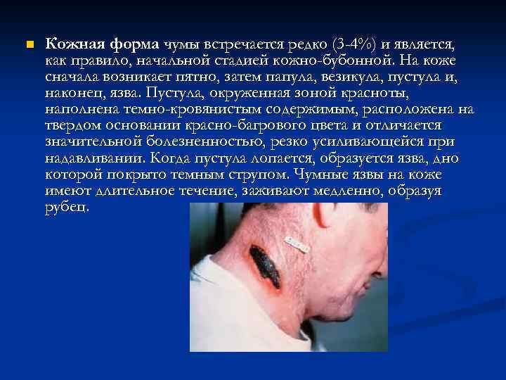 n Кожная форма чумы встречается редко (3 -4%) и является, как правило, начальной стадией