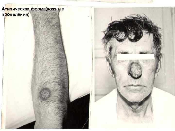 Атипическая форма(кожные проявления) 