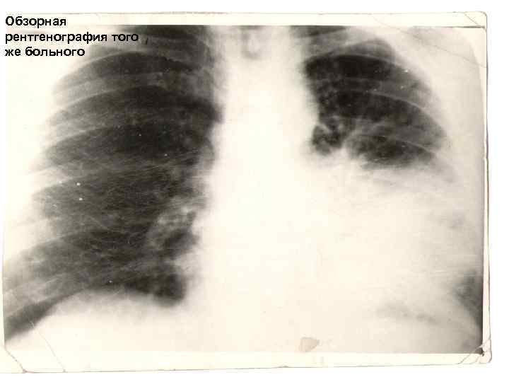 Обзорная рентгенография того же больного 