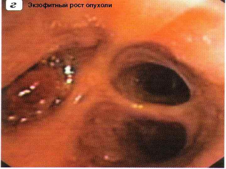 Экзофитный рост опухоли 