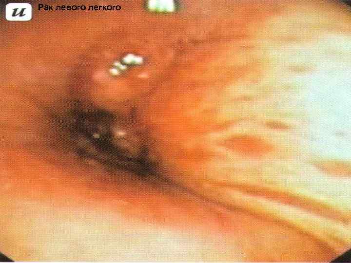 Рак левого легкого 