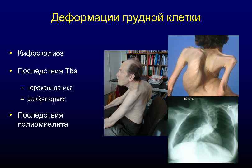 Деформации грудной клетки • Кифосколиоз • Последствия Tbs – торакопластика – фиброторакс • Последствия