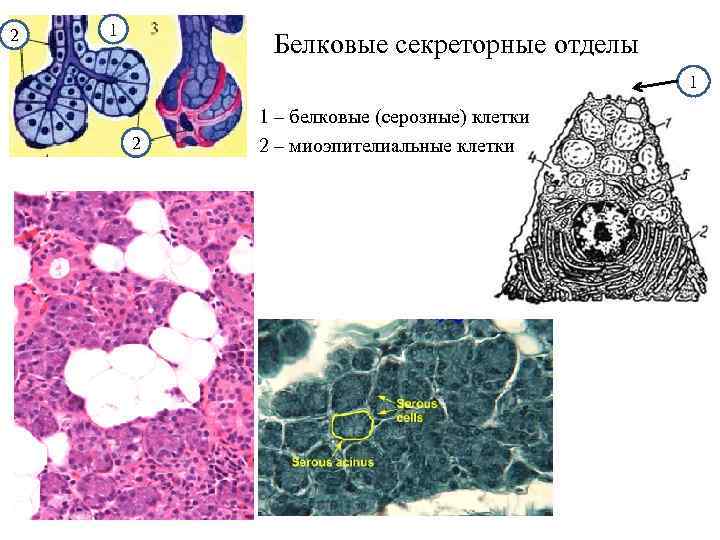 Гиперплазированный железистый эпителий на фоне крови