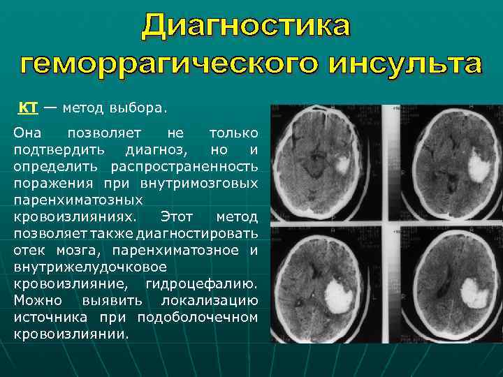 КТ — метод выбора. Она позволяет не только подтвердить диагноз, но и определить распространенность