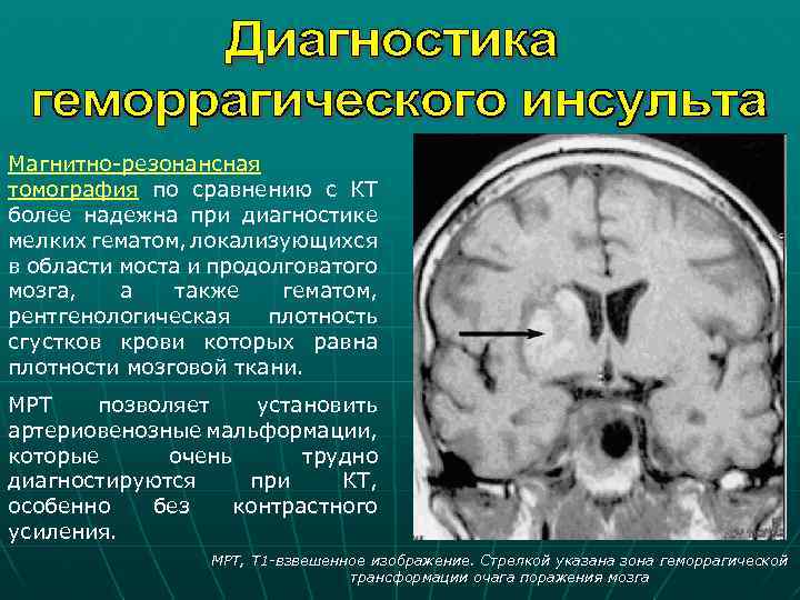 Магнитно-резонансная томография по сравнению с КТ более надежна при диагностике мелких гематом, локализующихся в
