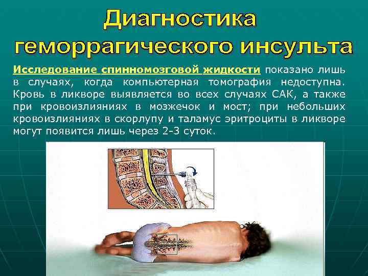 Исследование спинномозговой жидкости показано лишь в случаях, когда компьютерная томография недоступна. Кровь в ликворе