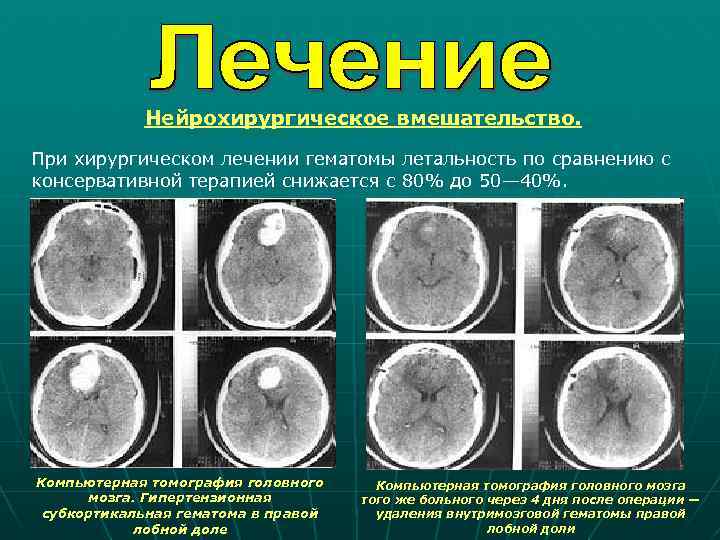 Нейрохирургическое вмешательство. При хирургическом лечении гематомы летальность по сравнению с консервативной терапией снижается с