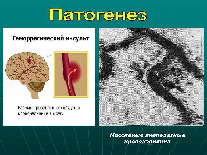 Массивные диапедезные кровоизлияния 