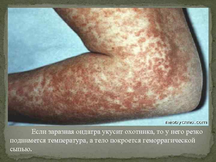 Если заразная ондатра укусит охотника, то у него резко поднимется температура, а тело покроется