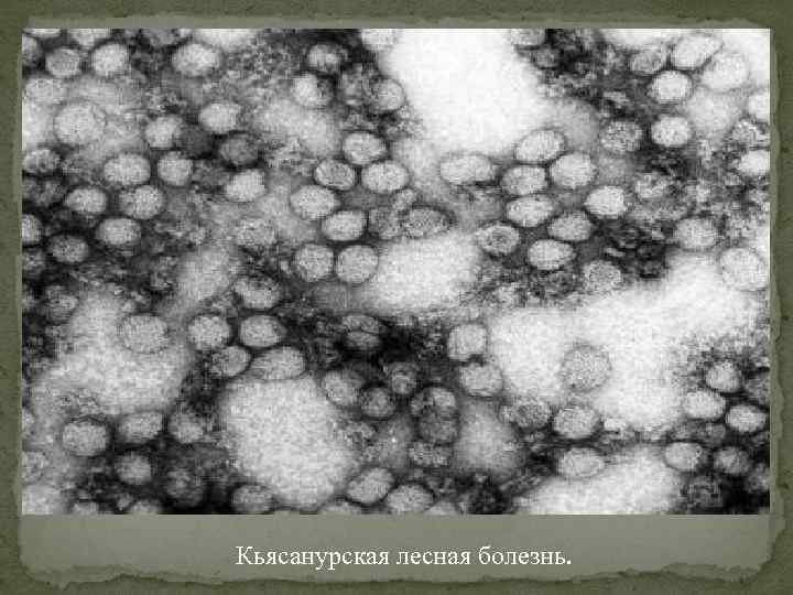 Кьясанурская лесная болезнь. 