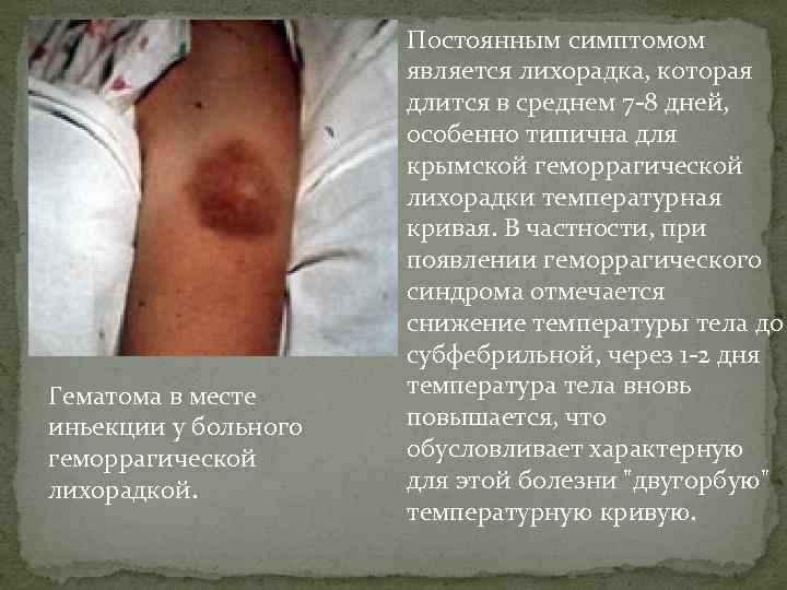 Гематома в месте иньекции у больного геморрагической лихорадкой. Постоянным симптомом является лихорадка, которая длится