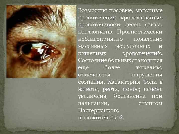 Возможны носовые, маточные кровотечения, кровохарканье, кровоточивость десен, языка, конъюнктив. Прогностически неблагоприятно появление массивных желудочных