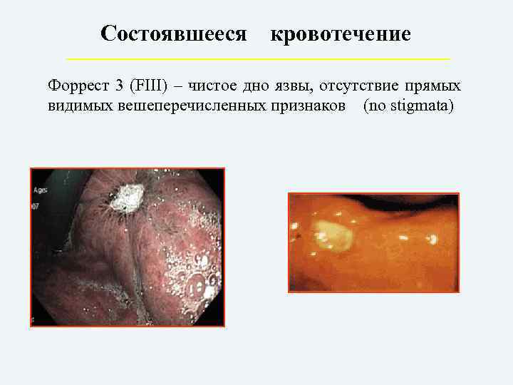 Состоявшееся кровотечение Форрест 3 (FIII) – чистое дно язвы, отсутствие прямых видимых вешеперечисленных признаков