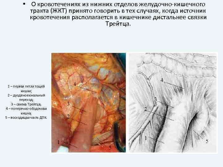  • О кровотечениях из нижних отделов желудочно-кишечного тракта (ЖКТ) принято говорить в тех