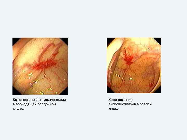 Колоноскопия: ангиодисплазия в восходящей ободочной кишке. Колоноскопия: ангиодисплазия в слепой кишке 