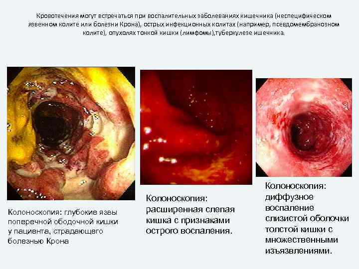 Кровотечения могут встречаться при воспалительных заболеваниях кишечника (неспецифическом язвенном колите или болезни Крона), острых