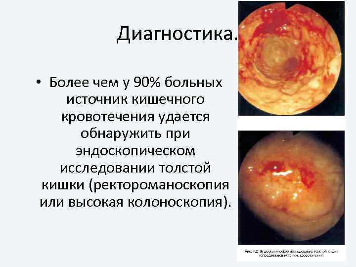 Диагностика. • Более чем у 90% больных источник кишечного кровотечения удается обнаружить при эндоскопическом