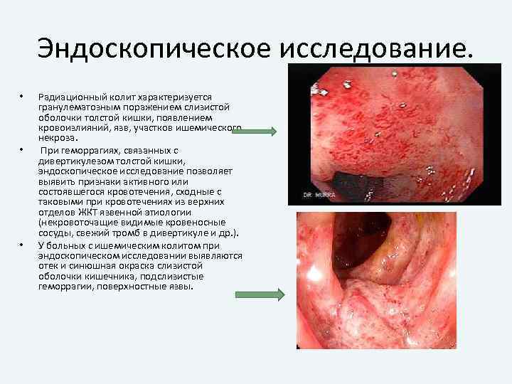 Эндоскопическое исследование. • • • Радиационный колит характеризуется гранулематозным поражением слизистой оболочки толстой кишки,