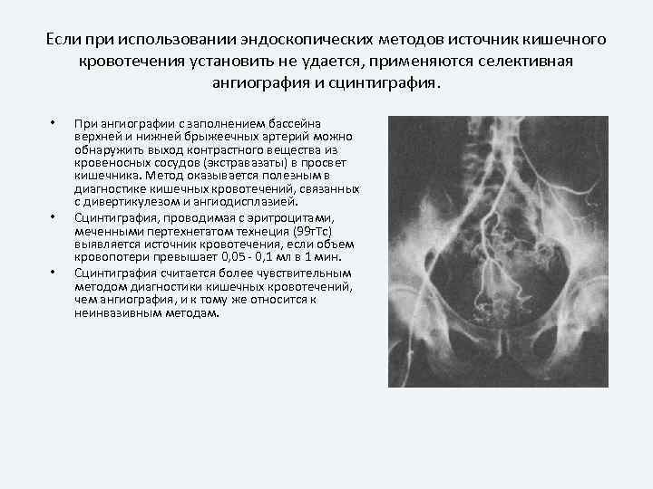 Если при использовании эндоскопических методов источник кишечного кровотечения установить не удается, применяются селективная ангиография