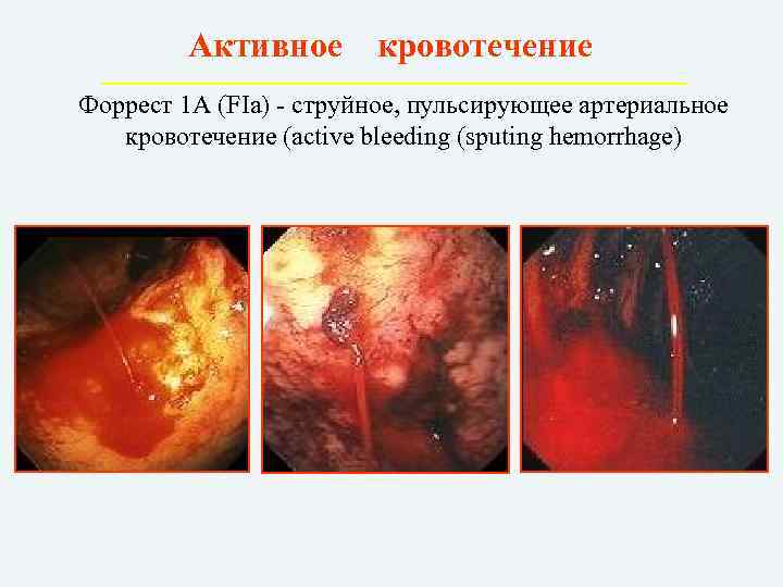 Активное кровотечение Форрест 1 А (FIa) - струйное, пульсирующее артериальное кровотечение (active bleeding (sputing