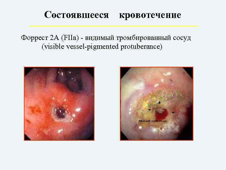 Состоявшееся кровотечение Форрест 2 А (FIIa) - видимый тромбированный сосуд (visible vessel-pigmented protuberance) 