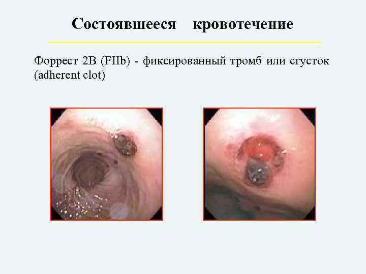 Состоявшееся кровотечение Форрест 2 В (FIIb) - фиксированный тромб или сгусток (adherent clot) 