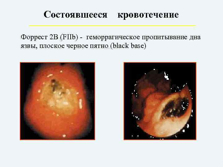 Состоявшееся кровотечение Форрест 2 В (FIIb) - геморрагическое пропитывание дна язвы, плоское черное пятно