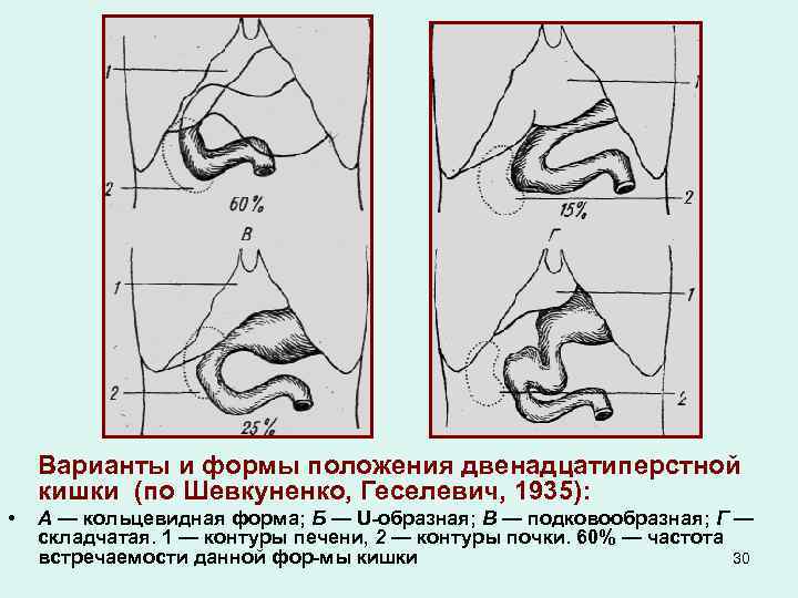Варианты и формы положения двенадцатиперстной кишки (по Шевкуненко, Геселевич, 1935): • А — кольцевидная