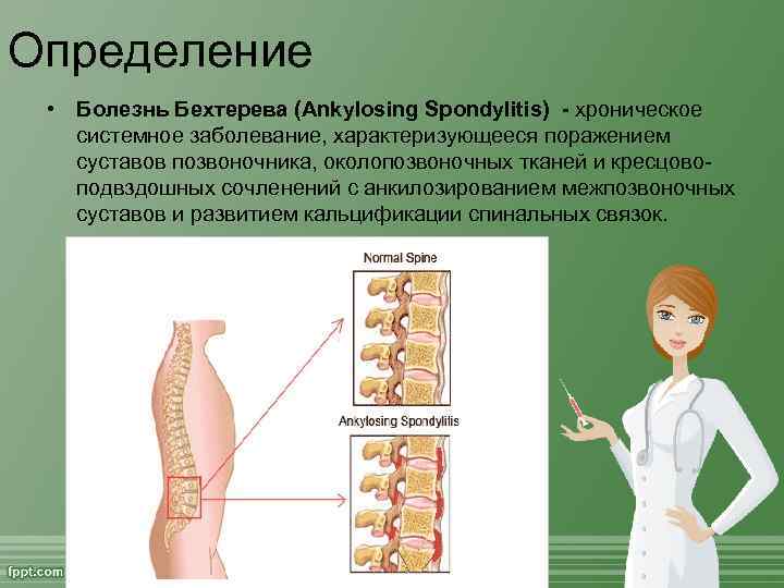 Определение • Болезнь Бехтерева (Ankylosing Spondylitis) - хроническое системное заболевание, характеризующееся поражением суставов позвоночника,