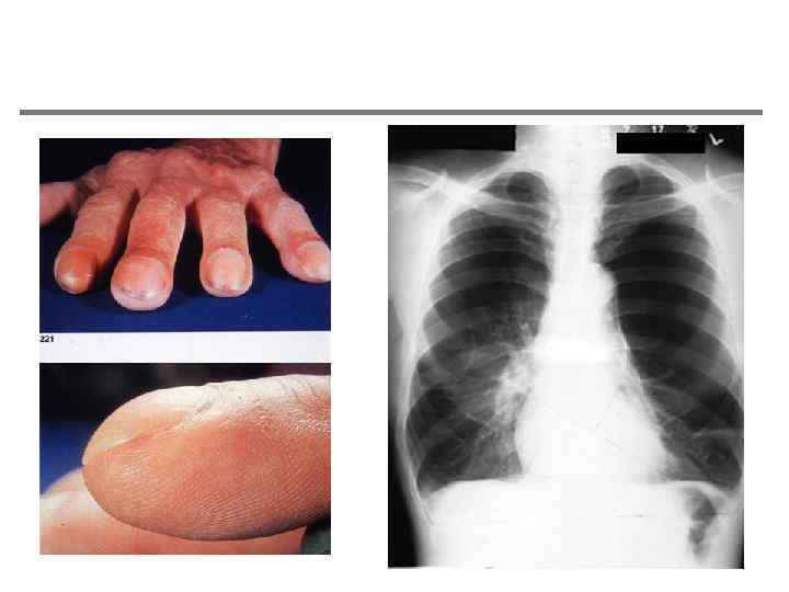Изменение ногтей Следствие хронической гипоксии 