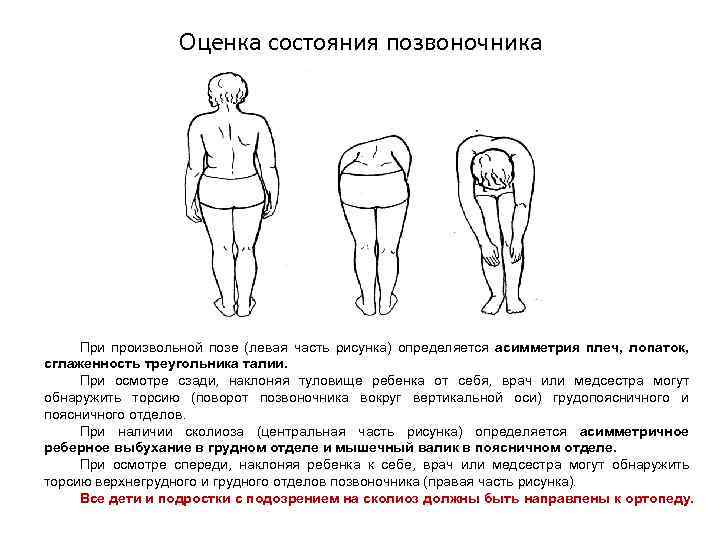 Оценка состояния позвоночника При произвольной позе (левая часть рисунка) определяется асимметрия плеч, лопаток, сглаженность