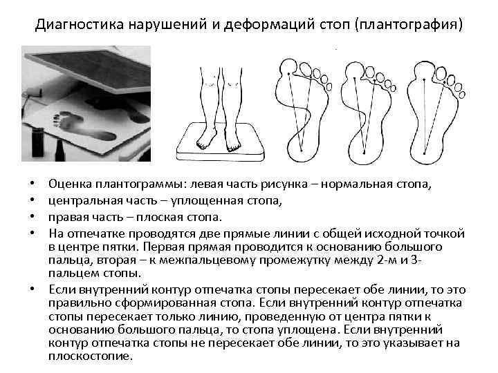 Диагностика нарушений и деформаций стоп (плантография) Оценка плантограммы: левая часть рисунка – нормальная стопа,