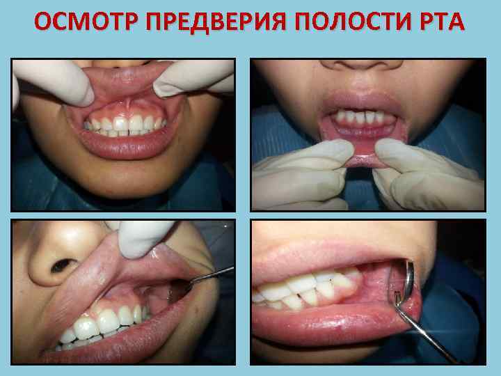 ОСМОТР ПРЕДВЕРИЯ ПОЛОСТИ РТА 