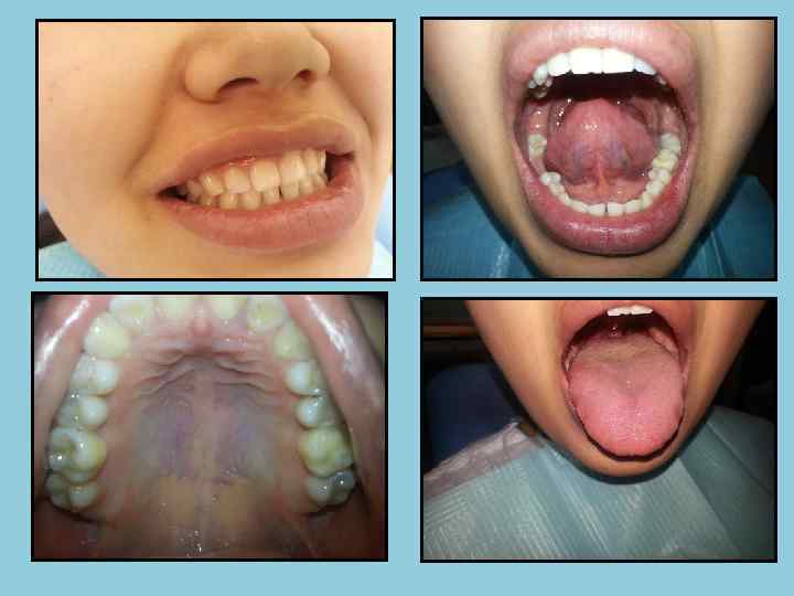  ПЕРКУССИЯ • Постукивание по зубу пинцетом или ручкой зонда (по режущему краю или