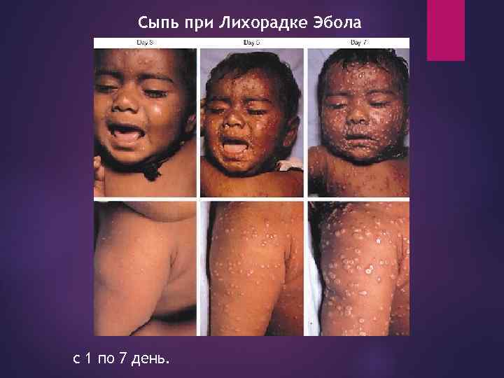 Сыпь при Лихорадке Эбола с 1 по 7 день. 