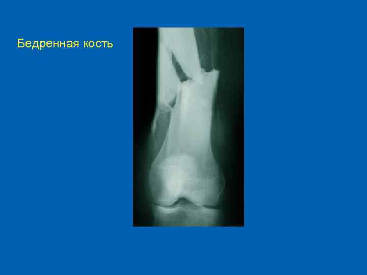 Бедренная кость 