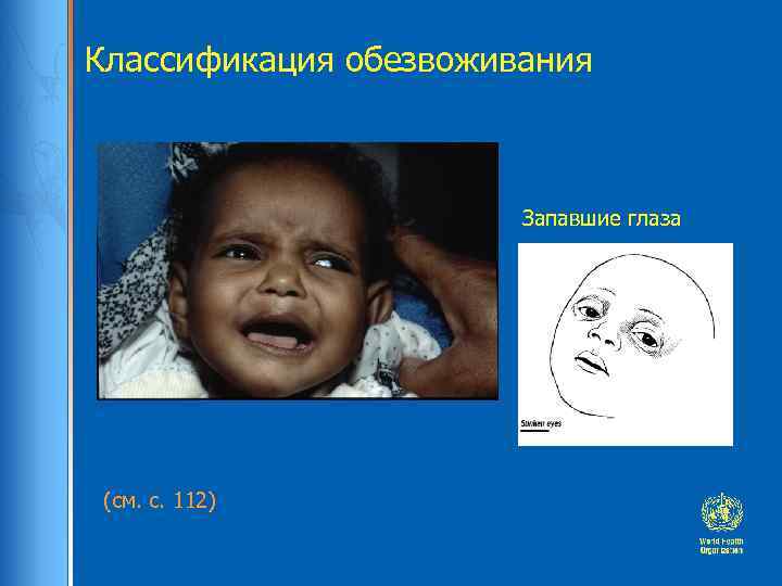 Классификация обезвоживания Запавшие глаза (см. с. 112) 