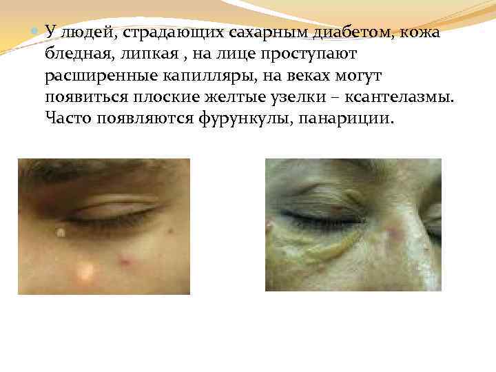  У людей, страдающих сахарным диабетом, кожа бледная, липкая , на лице проступают расширенные