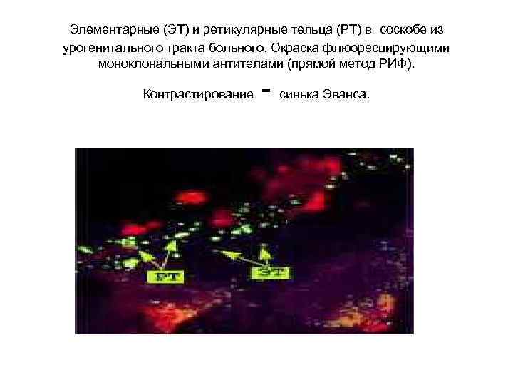  Элементарные (ЭТ) и ретикулярные тельца (РТ) в соскобе из урогенитального тракта больного. Окраска