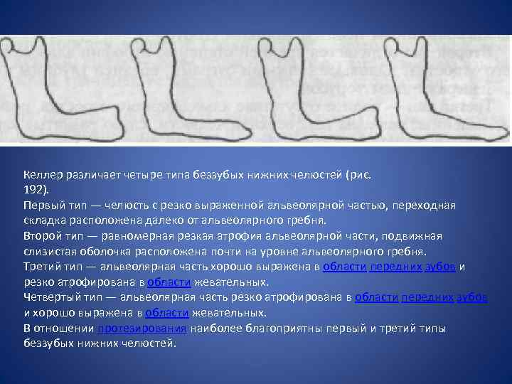 Келлер различает четыре типа беззубых нижних челюстей (рис. 192). Первый тип — челюсть с