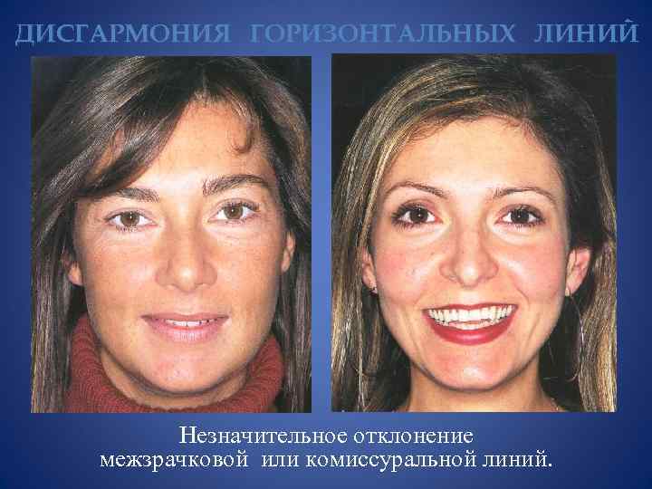 ДИСГАРМОНИЯ ГОРИЗОНТАЛЬНЫХ ЛИНИЙ Незначительное отклонение межзрачковой или комиссуральной линий. 