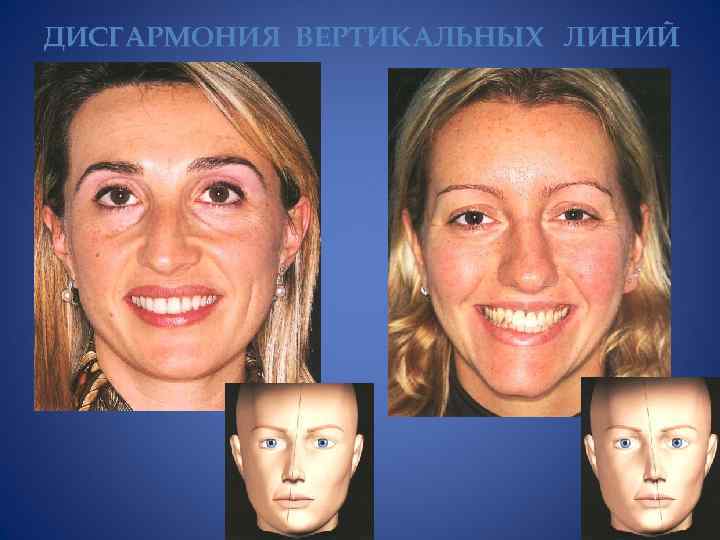 ДИСГАРМОНИЯ ВЕРТИКАЛЬНЫХ ЛИНИЙ 