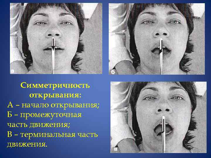 Симметричность открывания: А – начало открывания; Б – промежуточная часть движения; В – терминальная