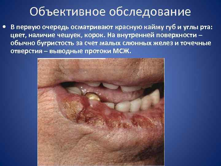 Объективное обследование • В первую очередь осматривают красную кайму губ и углы рта: цвет,