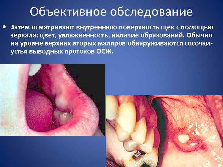 Объективное обследование • Затем осматривают внутреннюю поверхность щек с помощью зеркала: цвет, увлажненность, наличие