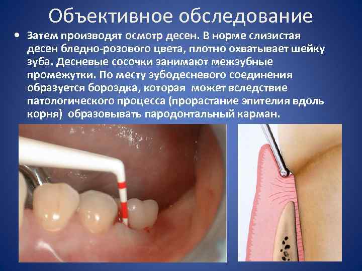 Объективное обследование • Затем производят осмотр десен. В норме слизистая десен бледно-розового цвета, плотно