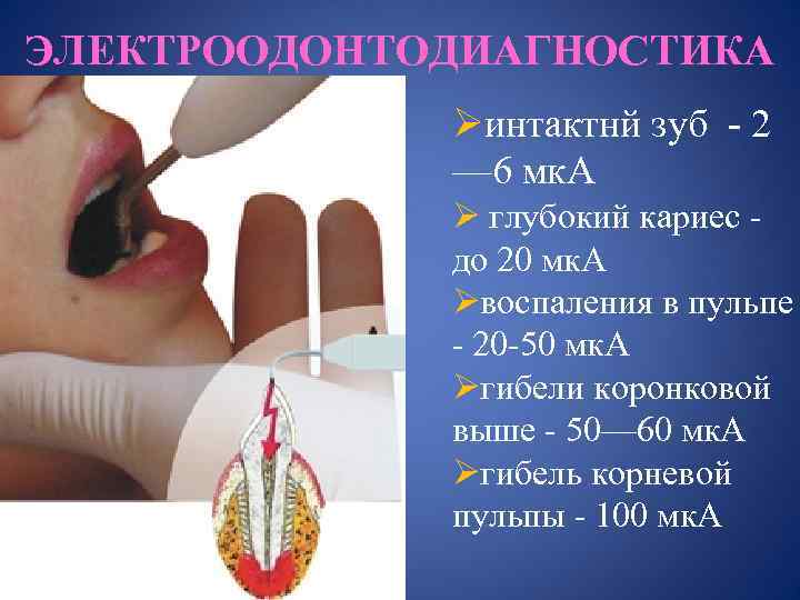 ЭЛЕКТРООДОНТОДИАГНОСТИКА Øинтактнй зуб - 2 — 6 мк. А Ø глубокий кариес до 20