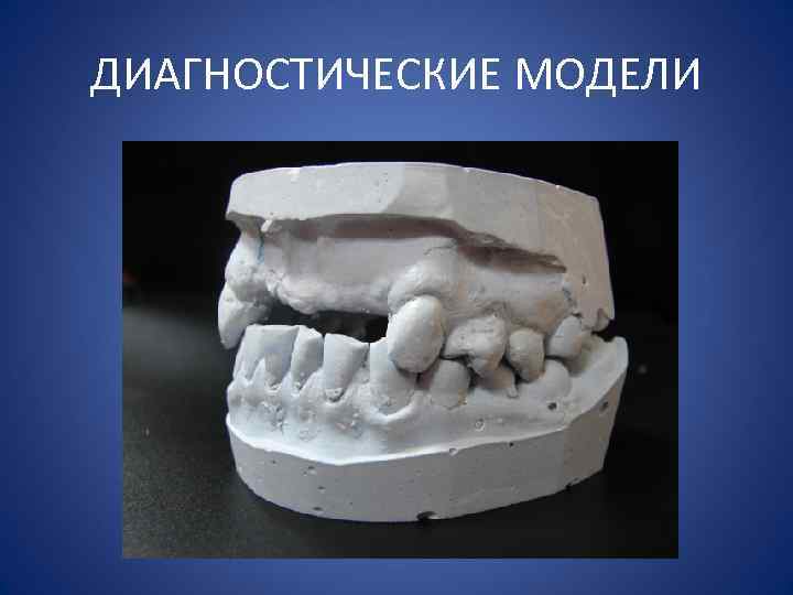 Изготовление гипсовой модели. Гипсовая модель зубов. Отливка диагностических моделей. Диагностические гипсовые модели. Гипсовые модели в стоматологии.