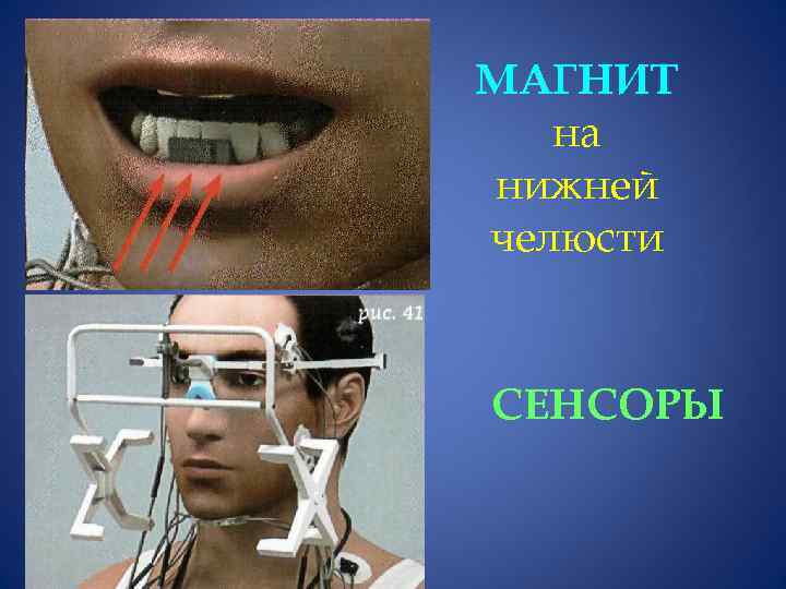 МАГНИТ на нижней челюсти СЕНСОРЫ 